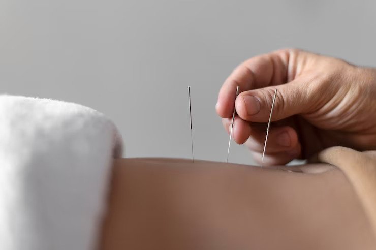 Get Acupuncture For Pregnancy